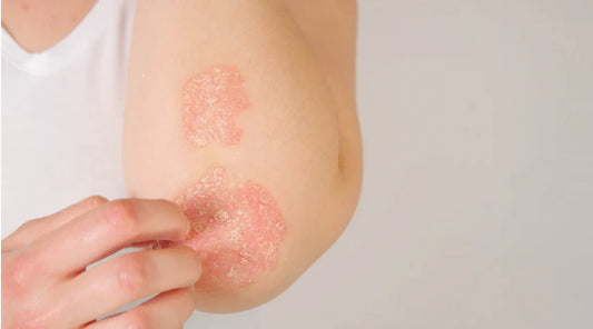 All about psoriasis